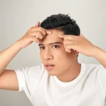 Stop Jerawat Dahi: Kenali Sebab & Cara Usirnya