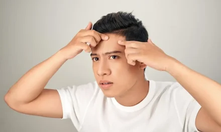 Stop Jerawat Dahi: Kenali Sebab & Cara Usirnya