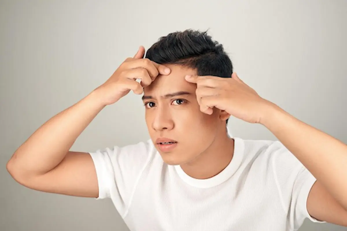 Stop Jerawat Dahi: Kenali Sebab & Cara Usirnya